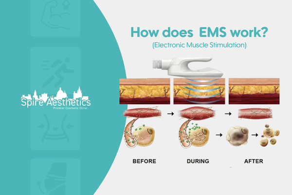 EMS treatment for post pregnancy weight loss treatment Handsworth