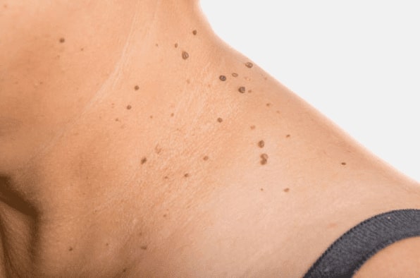 Are you looking for easy skin tag removal Handsworth - then contact Spire today!