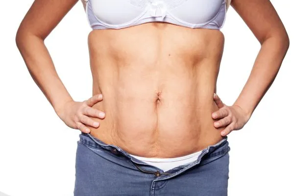 sagging skin on woman's stomach after weight loss injections Handsworth