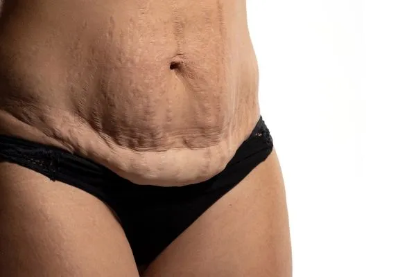 Image of womans stomach after weight loss injections Handsworth showing saggy skin